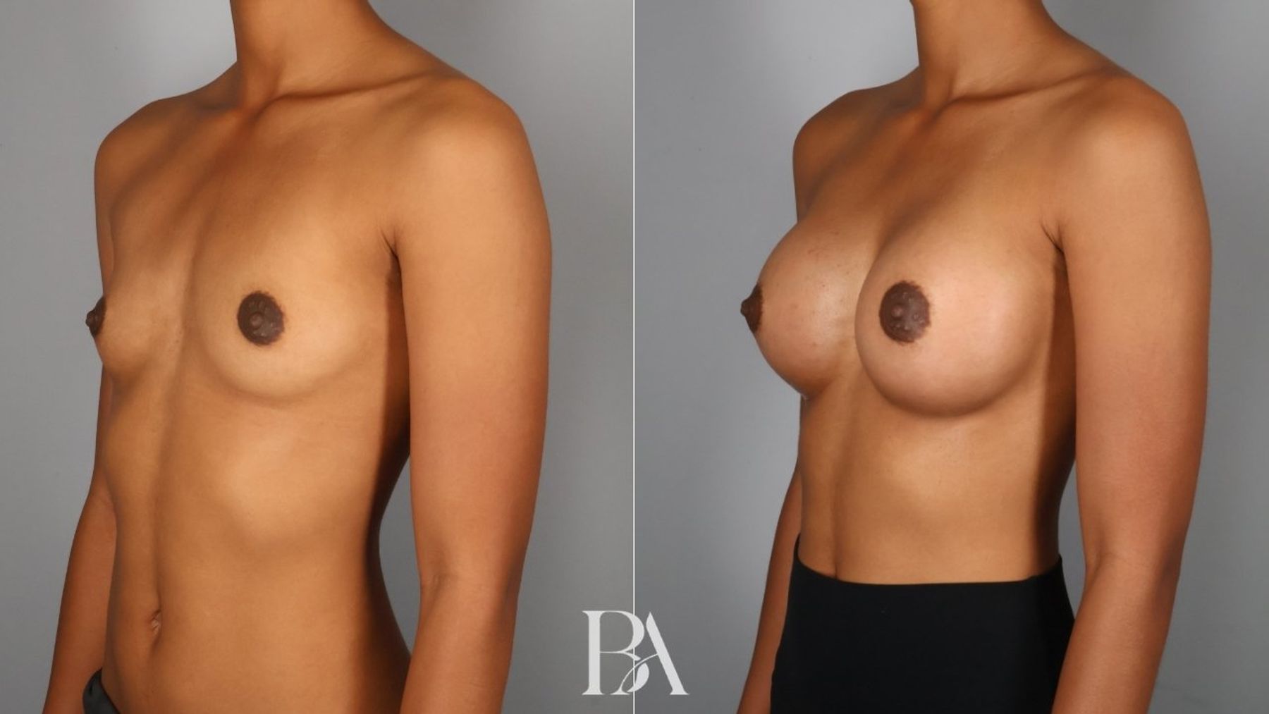 Breast augmentation before and after — three-quarter view, Dr. Beina Azadgoli, Beverly Hills