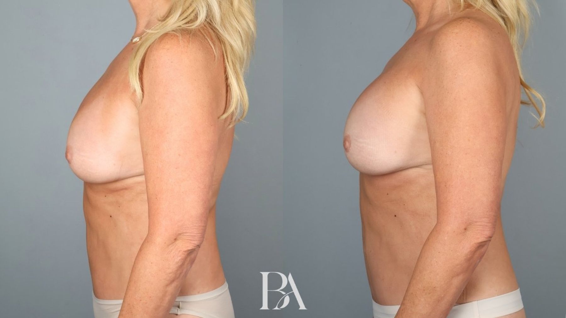 Implant Removal and Replacement before and after — side view, Dr. Beina Azadgoli, Beverly Hills