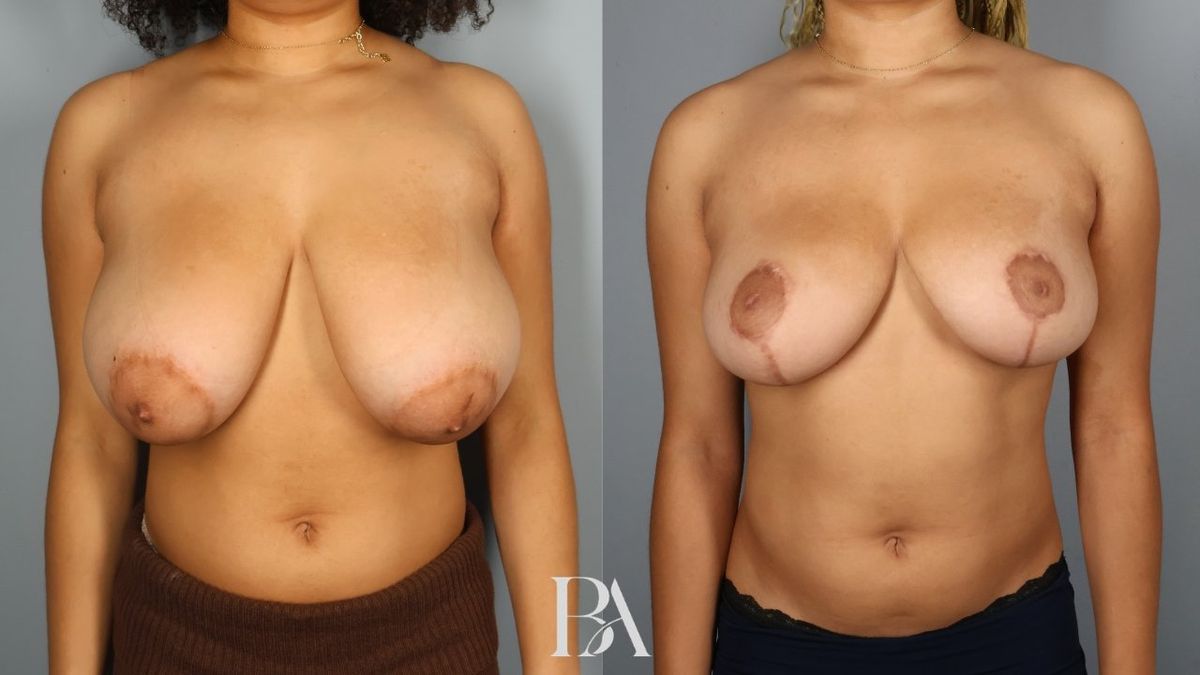 Before and after — Breast Reduction