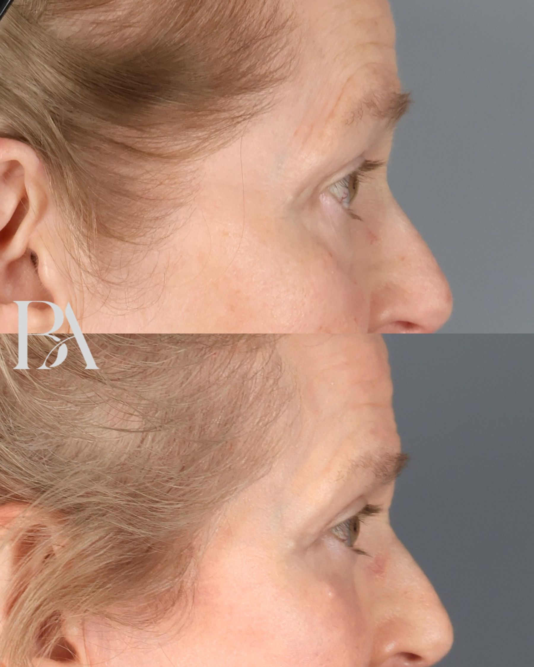 Upper Blepharoplasty before and after — side view, Dr. Beina Azadgoli, Beverly Hills