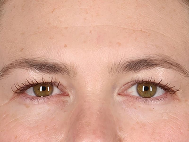 Before — Upper Blepharoplasty