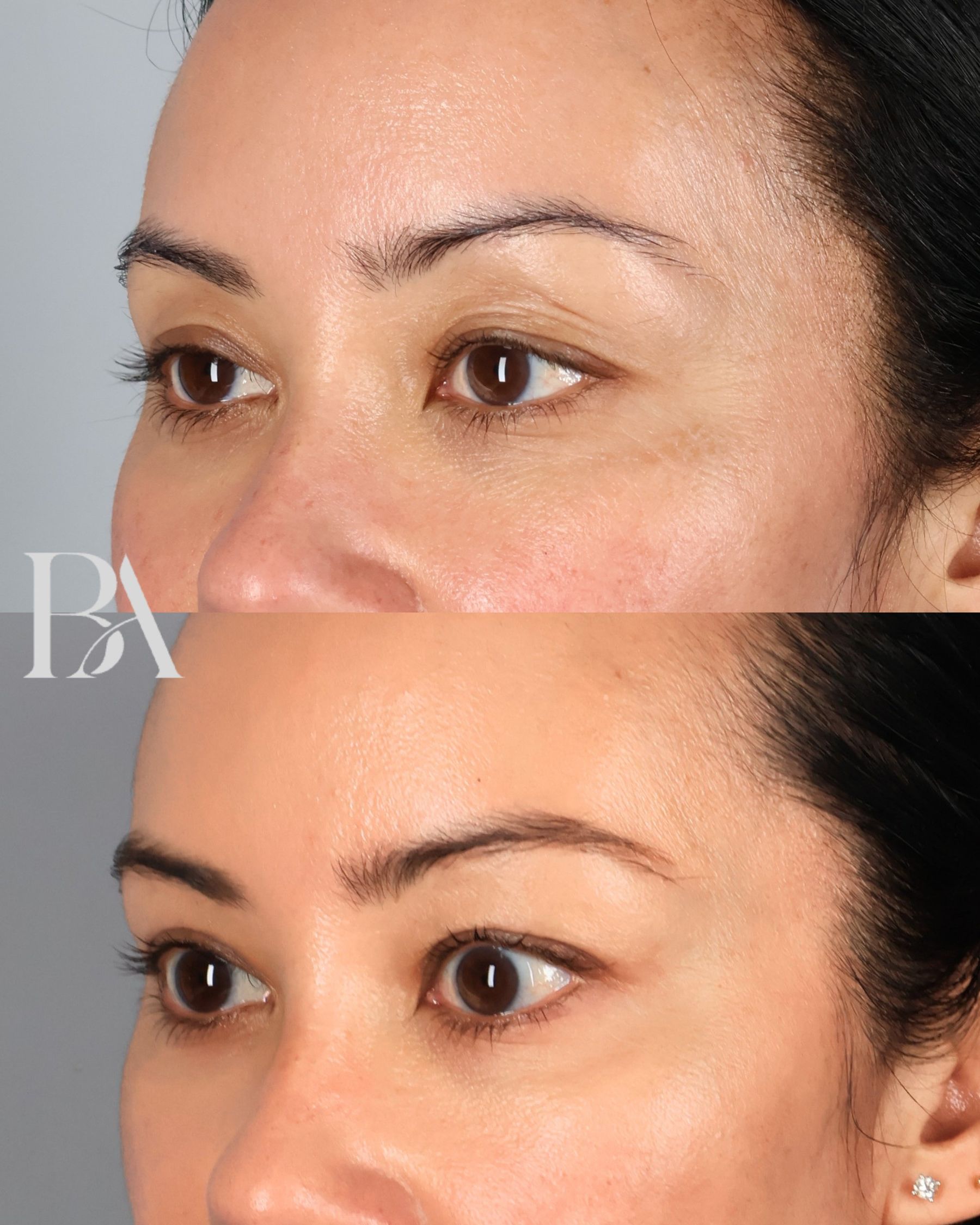 Upper Blepharoplasty before and after — three-quarter view, Dr. Beina Azadgoli, Beverly Hills