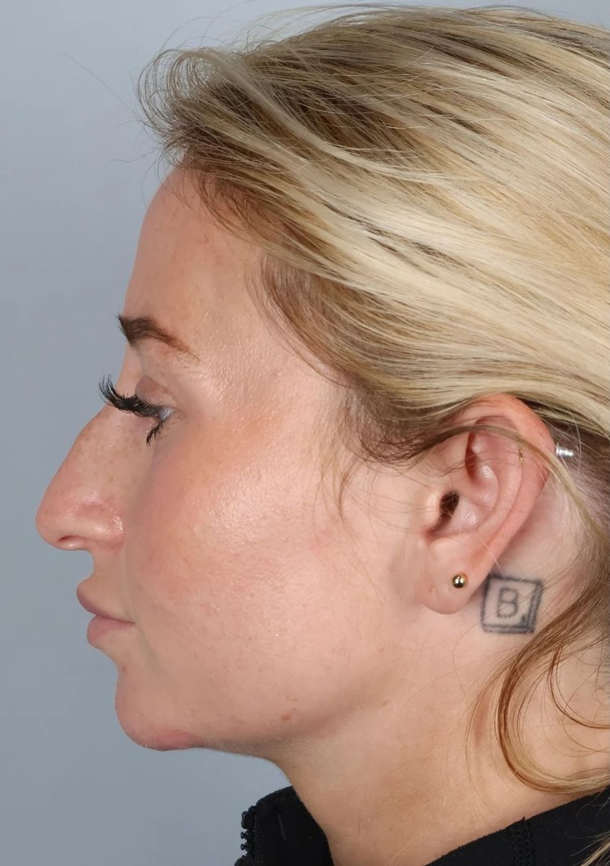 Case 3002 — Oblique before