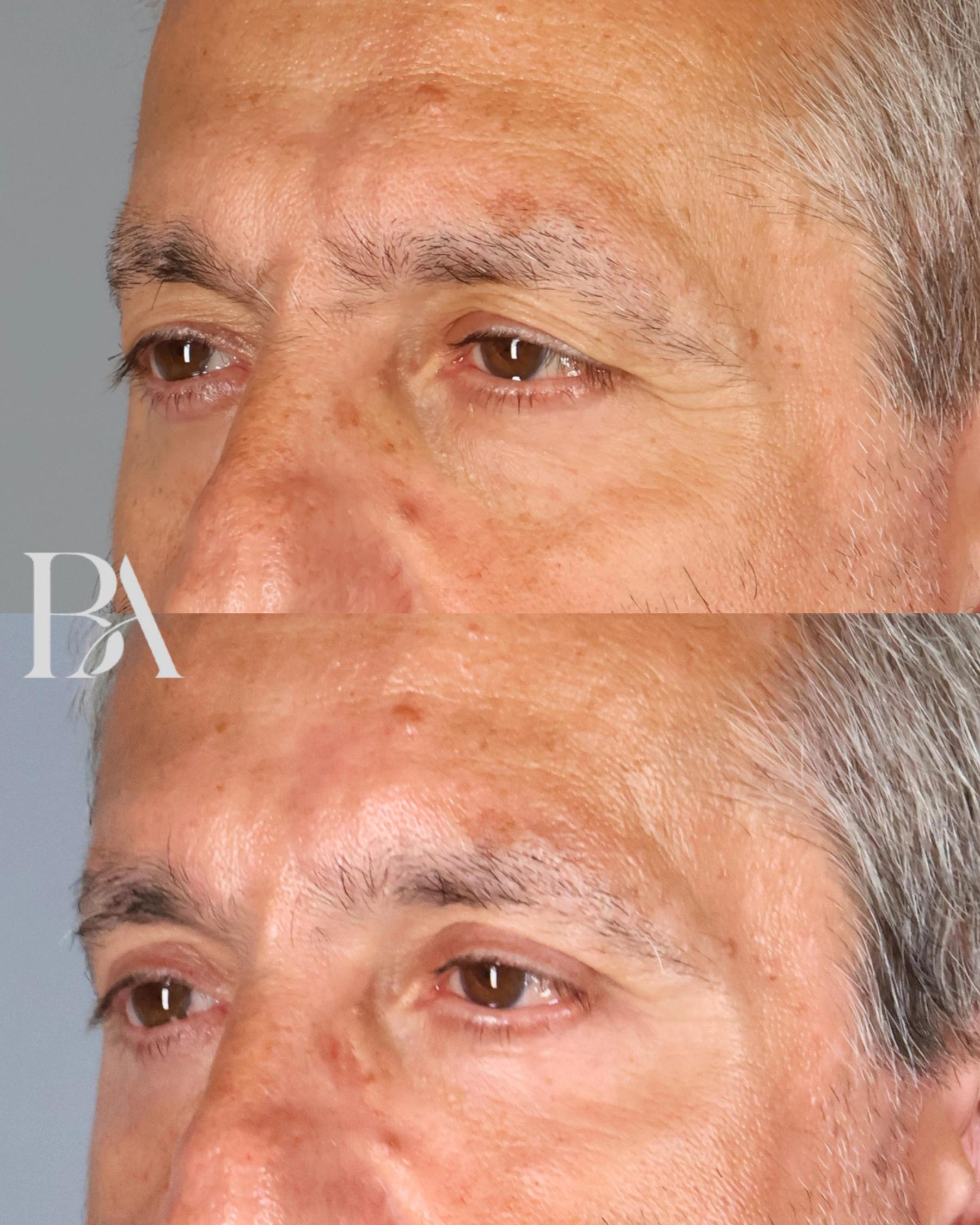 Upper Blepharoplasty before and after — three-quarter view, Dr. Beina Azadgoli, Beverly Hills