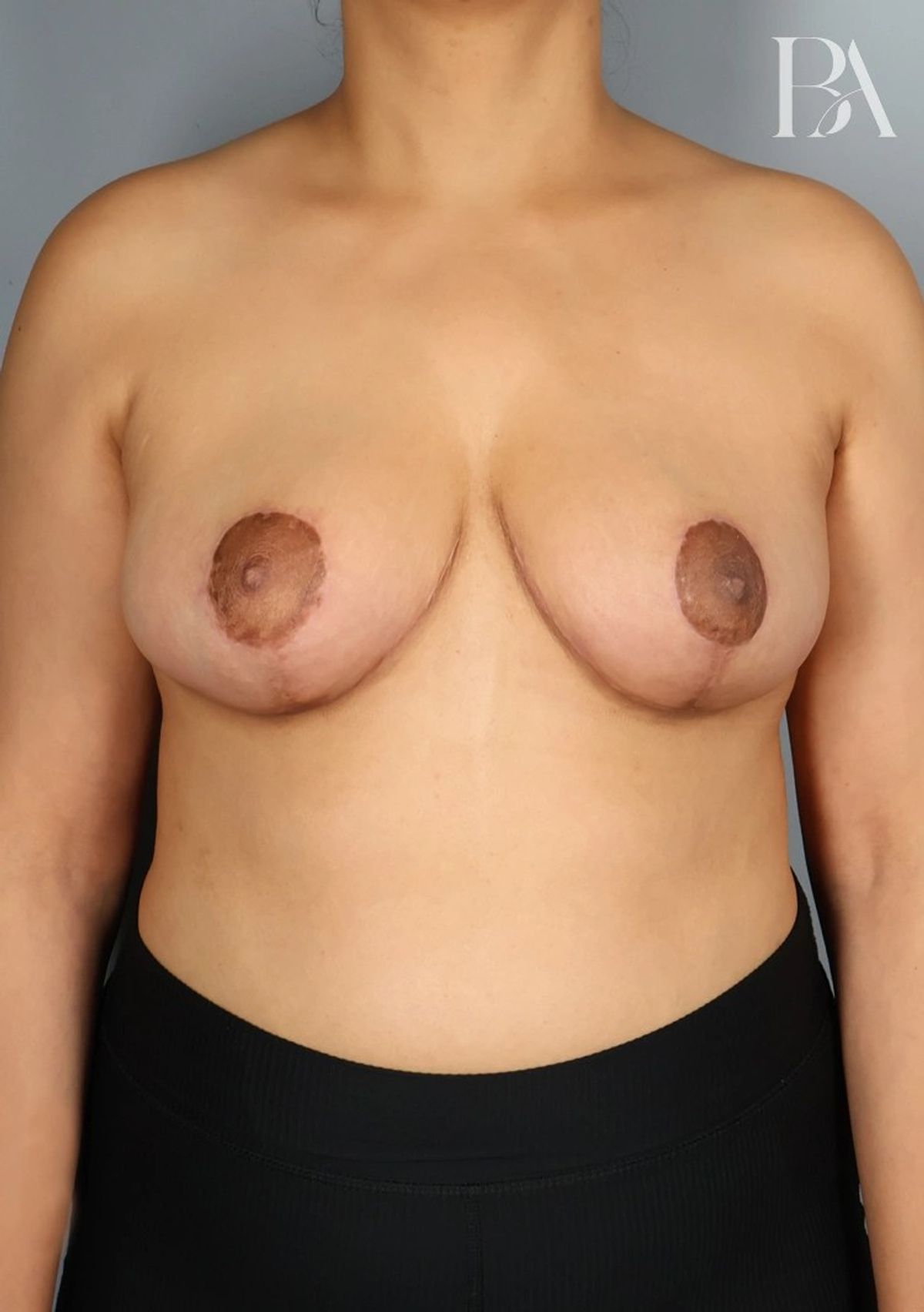 Case 1308 — Front after