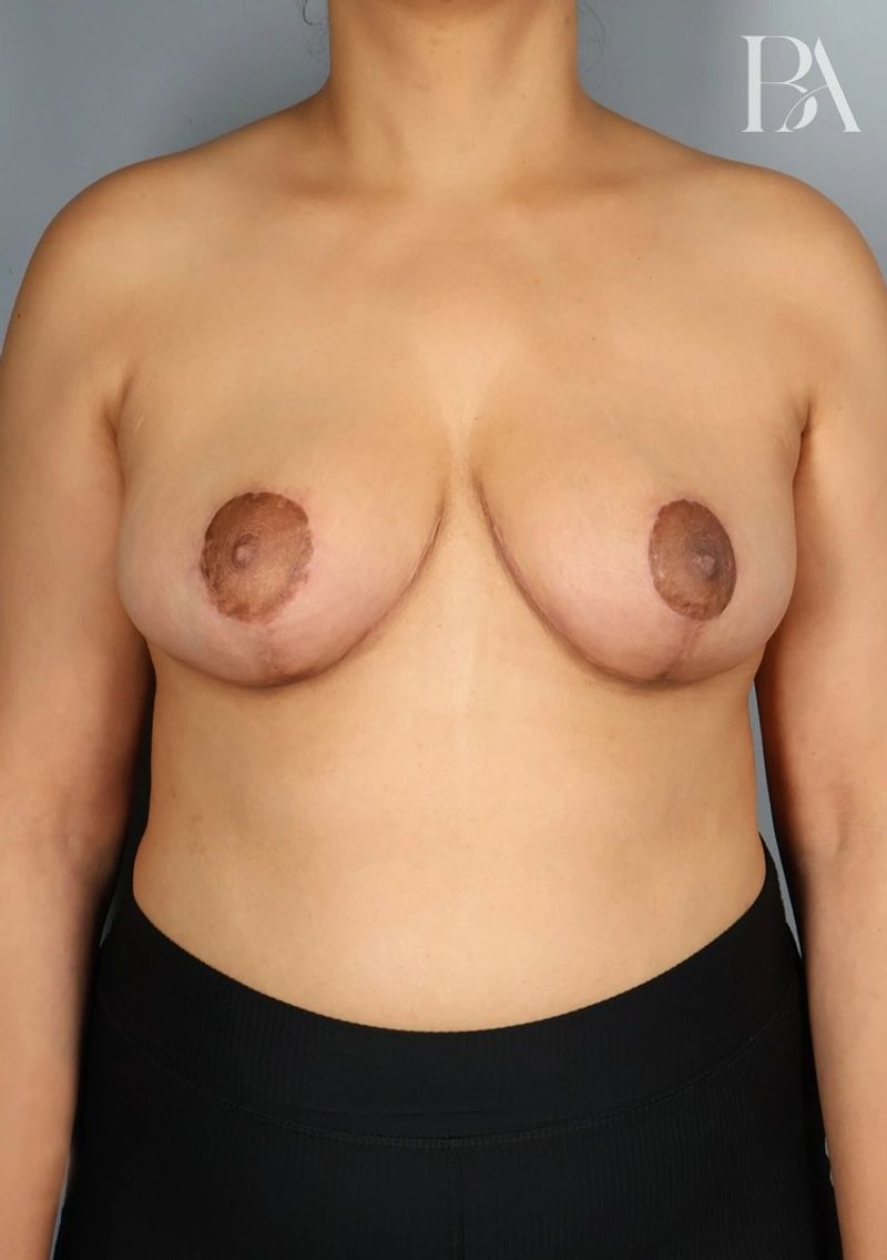 After — Breast Reduction