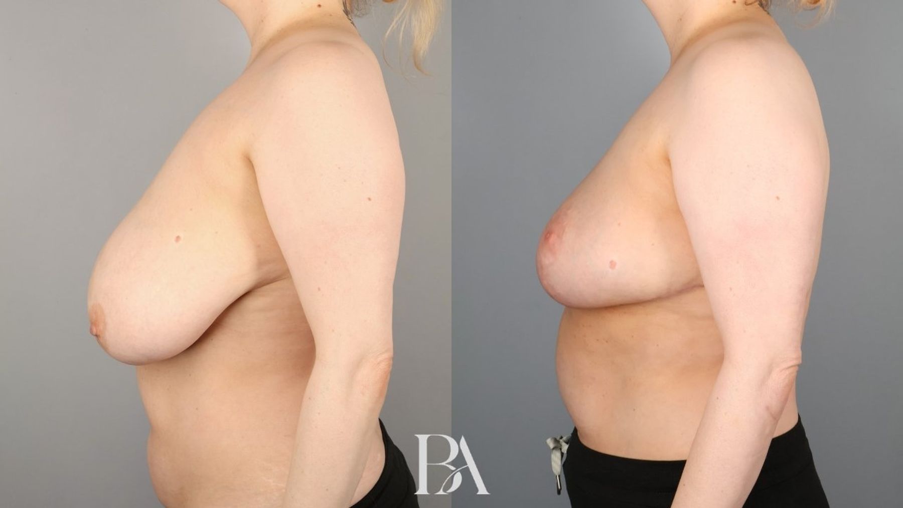 Oncoplastic Reduction before and after — side view, Dr. Beina Azadgoli, Beverly Hills