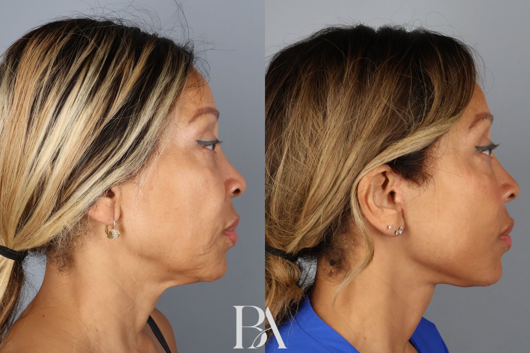 Face/Neck Lift before and after — side view, Dr. Beina Azadgoli, Beverly Hills