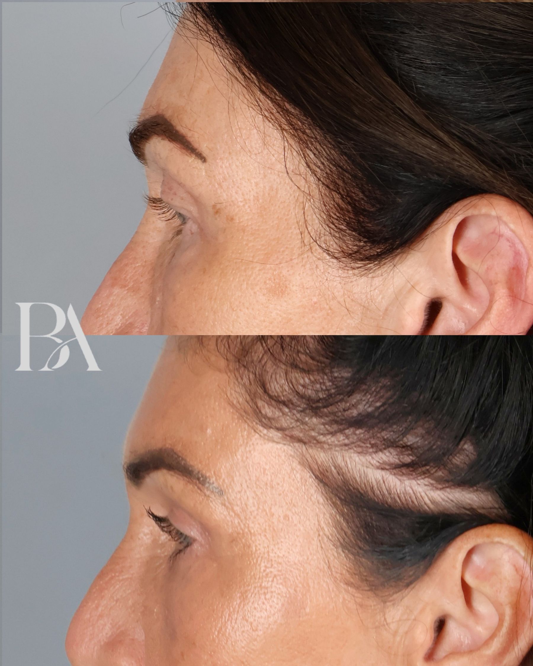 Upper Blepharoplasty before and after — side view, Dr. Beina Azadgoli, Beverly Hills