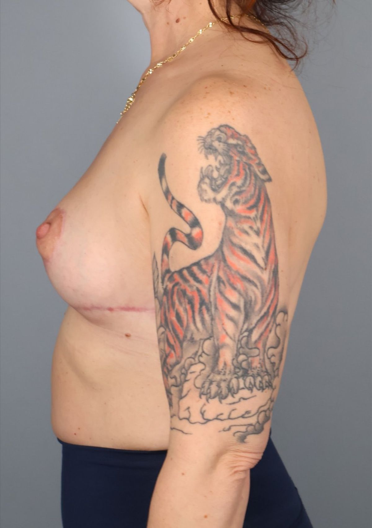 Breast reduction after — side view, Dr. Beina Azadgoli, Beverly Hills