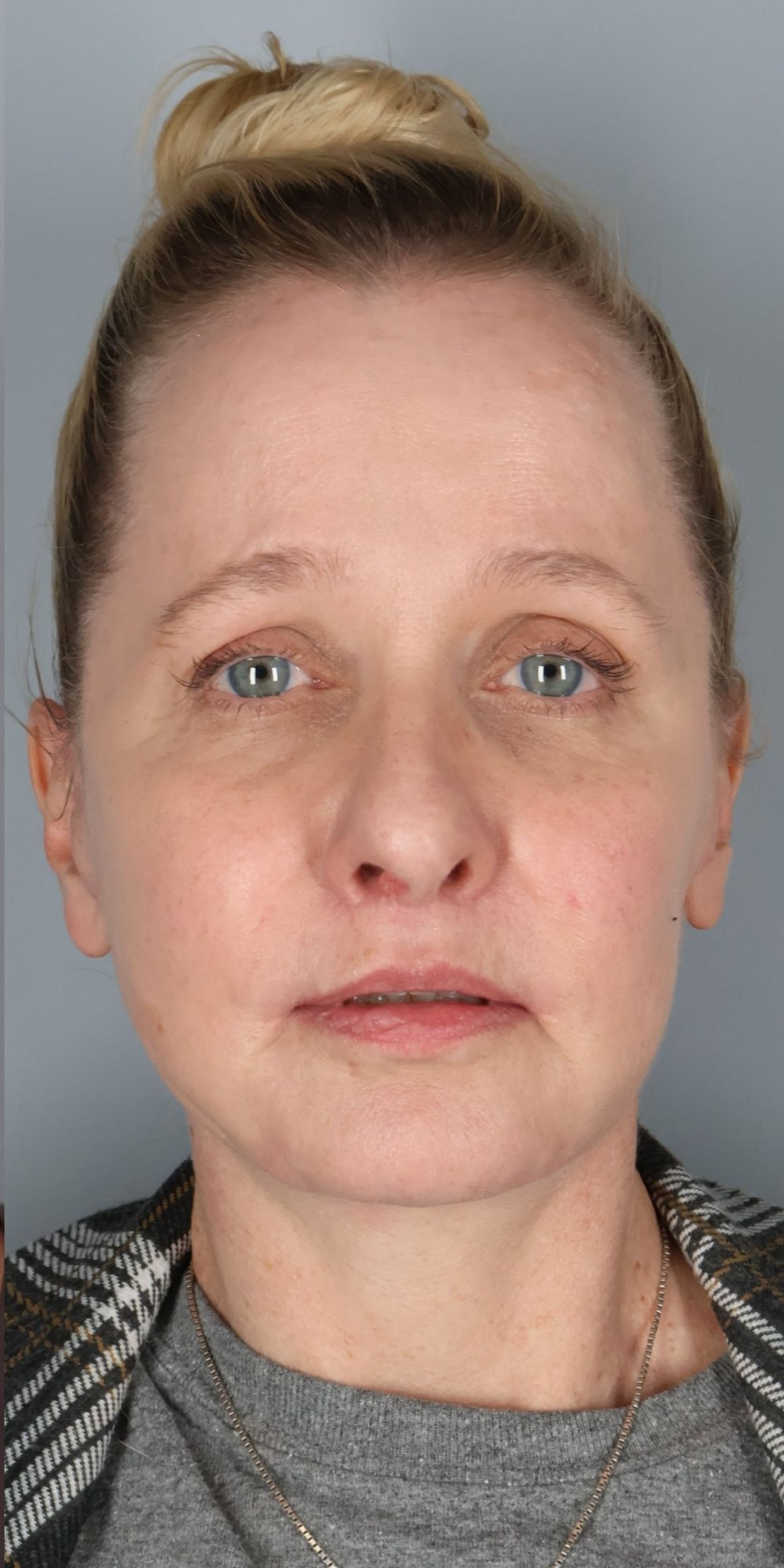 Face/neck lift after — detail view, Dr. Beina Azadgoli, Beverly Hills