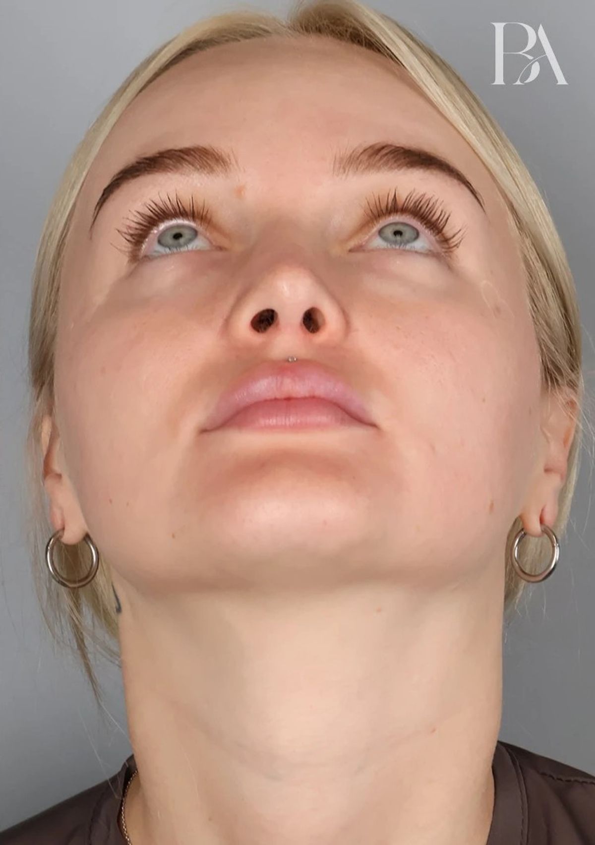 Case 3001 — Detail after