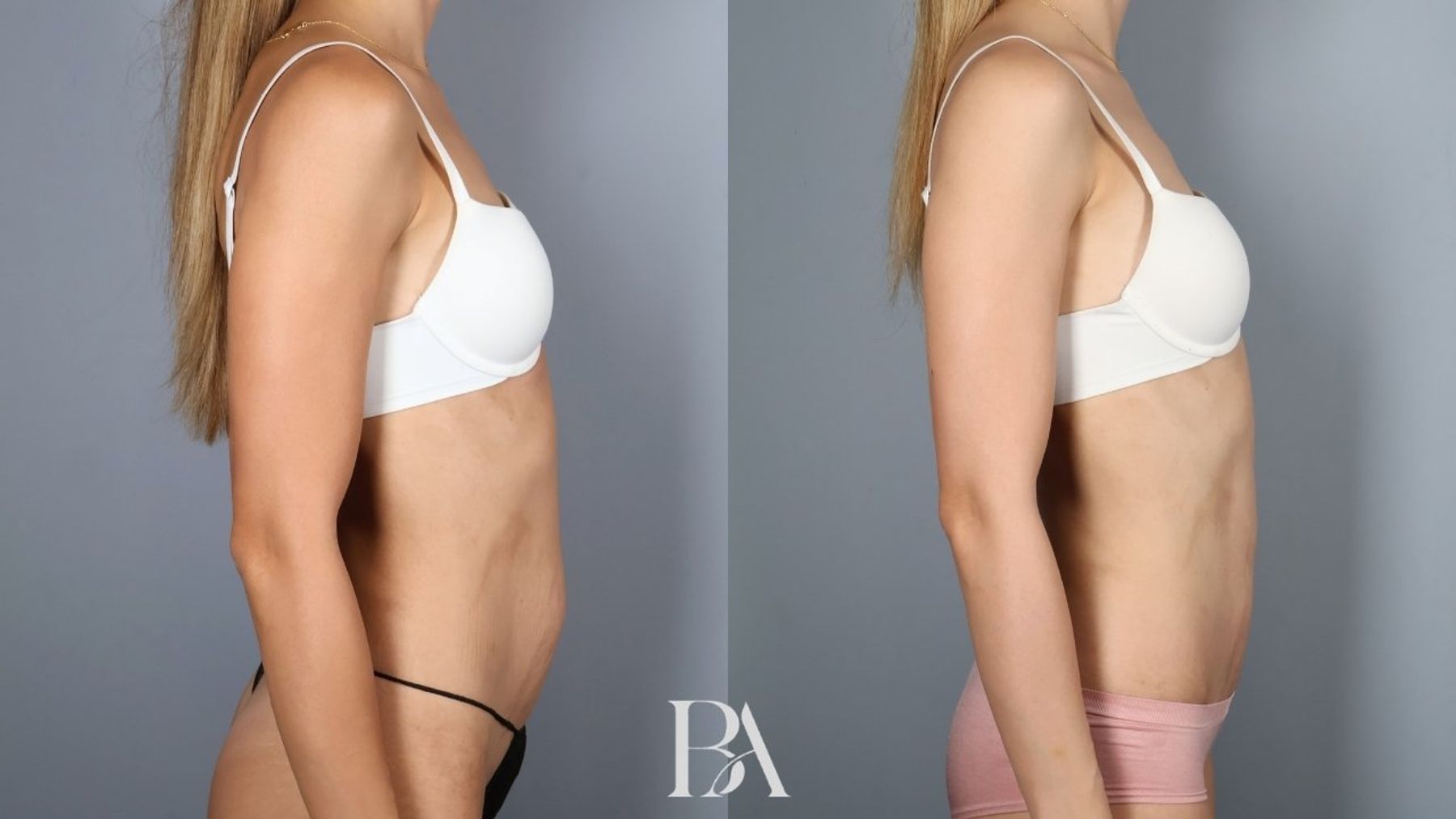 Tummy tuck before and after — side view, Dr. Beina Azadgoli, Beverly Hills