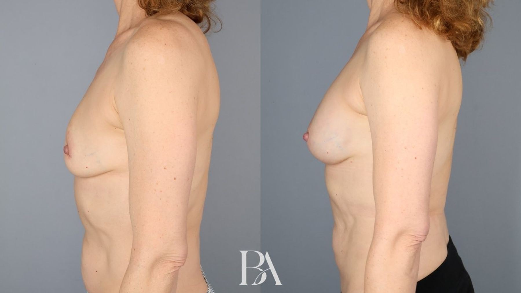 Direct-to-Implant Reconstruction before and after — side view, Dr. Beina Azadgoli, Beverly Hills