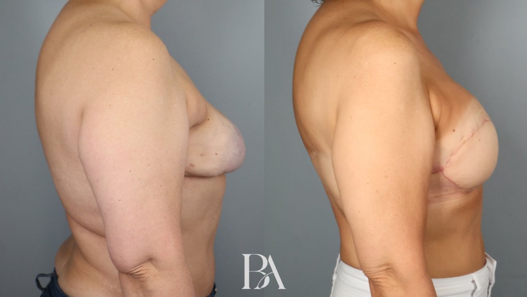 Breast Reconstruction Revision before and after — side view, Dr. Beina Azadgoli, Beverly Hills