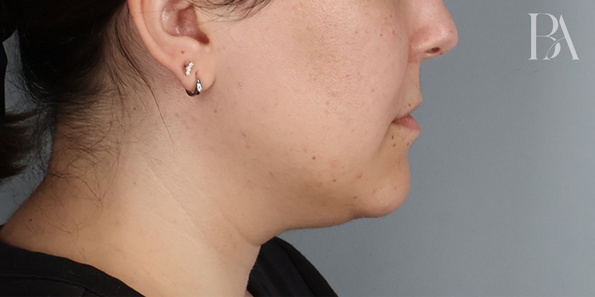 Submental liposuction before — three-quarter view, Dr. Beina Azadgoli, Beverly Hills