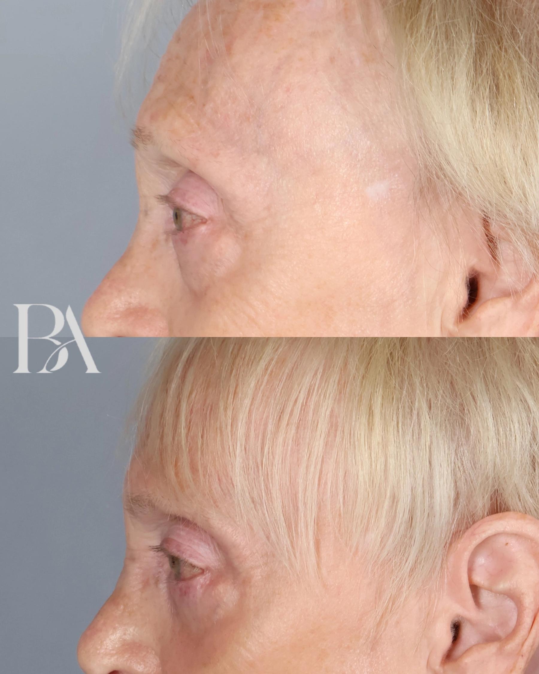 Lower Blepharoplasty before and after — side view, Dr. Beina Azadgoli, Beverly Hills