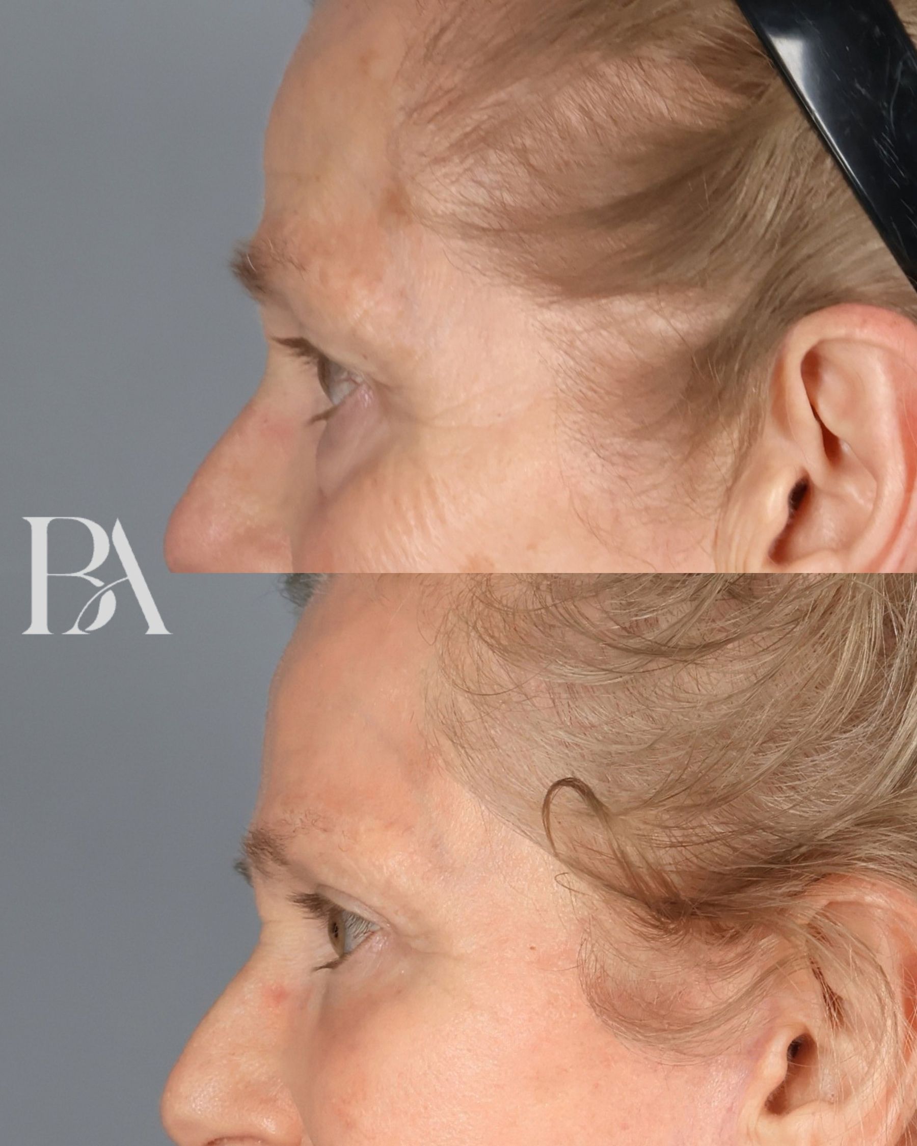 Upper Blepharoplasty before and after — side view, Dr. Beina Azadgoli, Beverly Hills