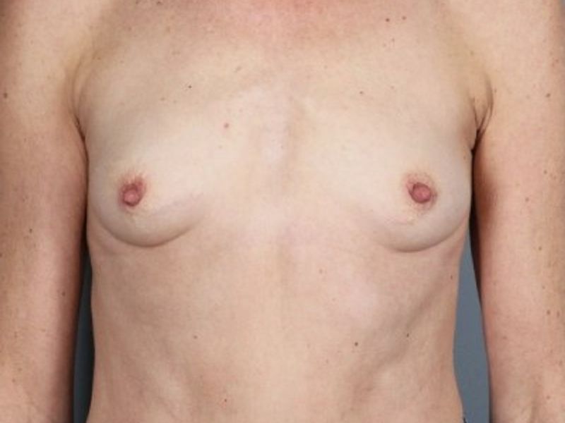 Before — Direct-to-Implant Reconstruction