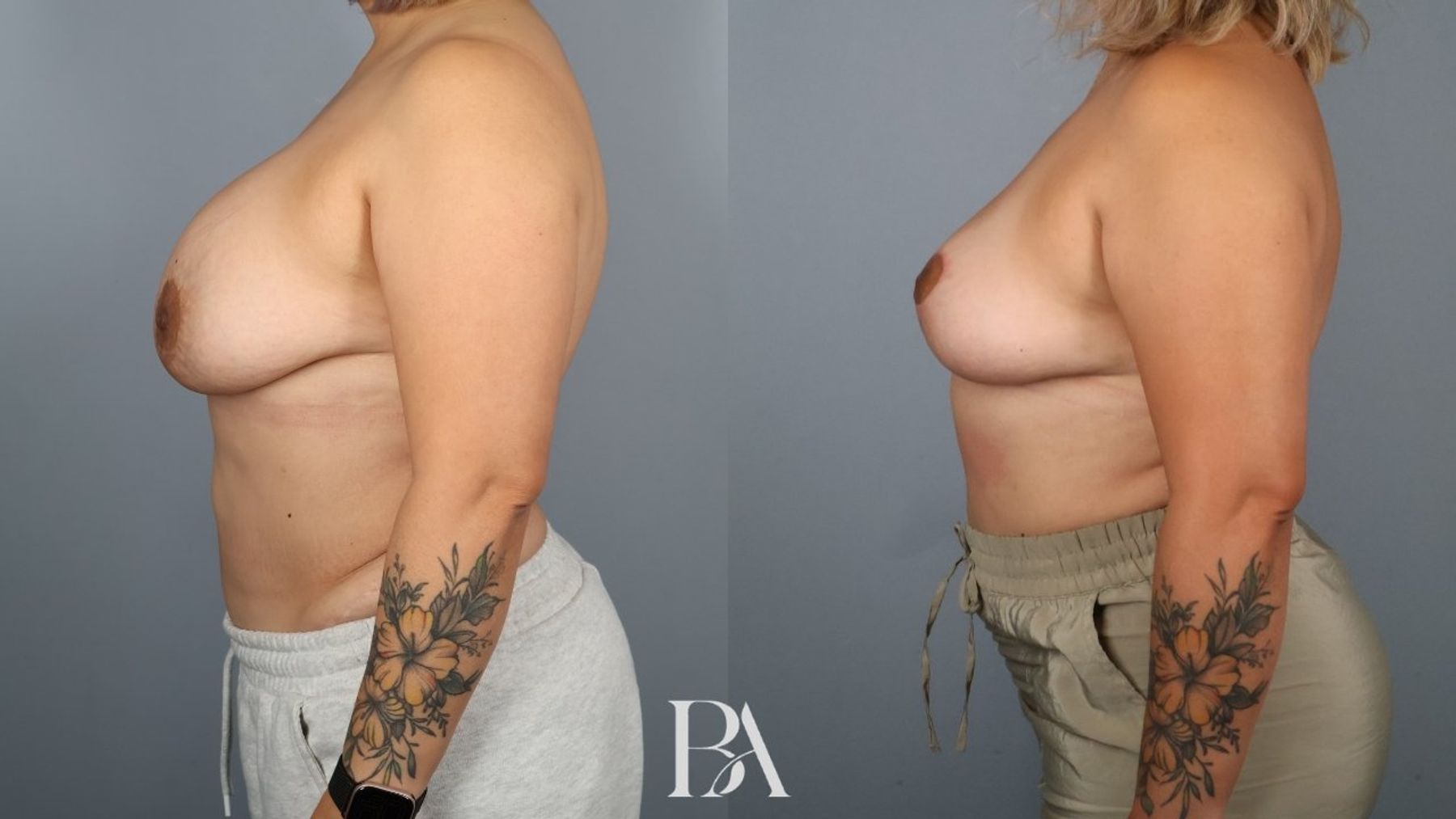 Breast implant removal before and after — side view, Dr. Beina Azadgoli, Beverly Hills