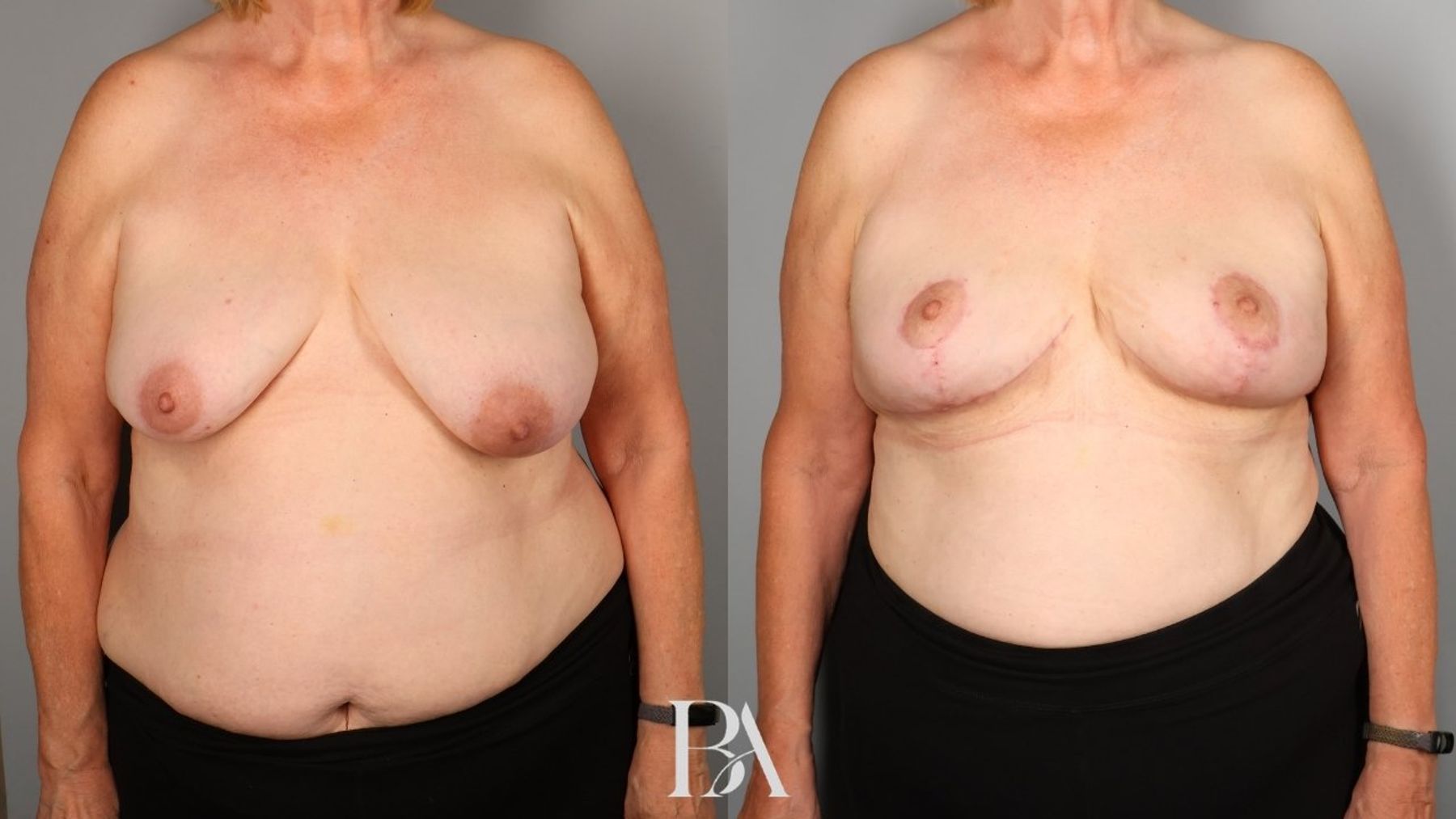 Oncoplastic Reduction before and after — front view, Dr. Beina Azadgoli, Beverly Hills