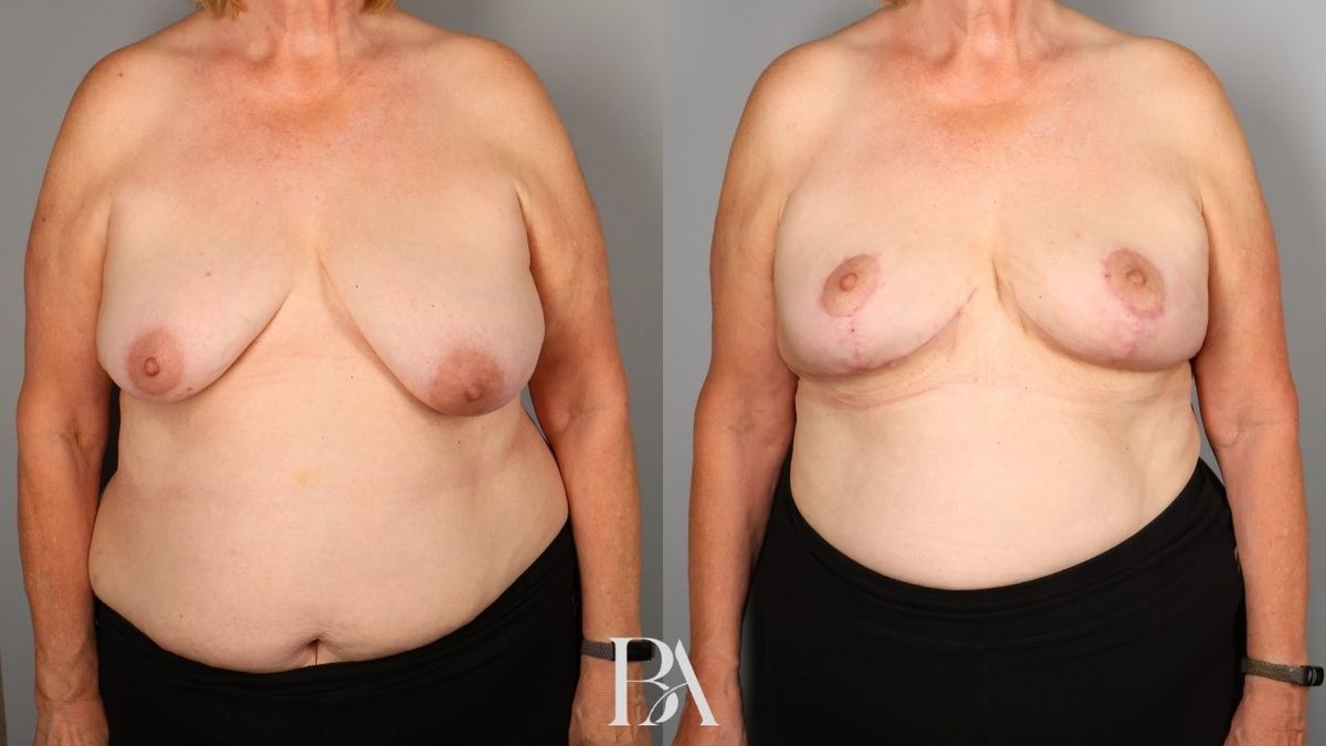 Oncoplastic Reduction before and after — front view, Dr. Beina Azadgoli, Beverly Hills