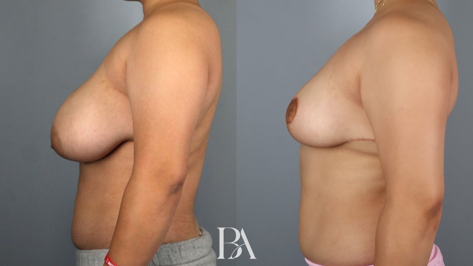Breast reduction before and after — side view, Dr. Beina Azadgoli, Beverly Hills