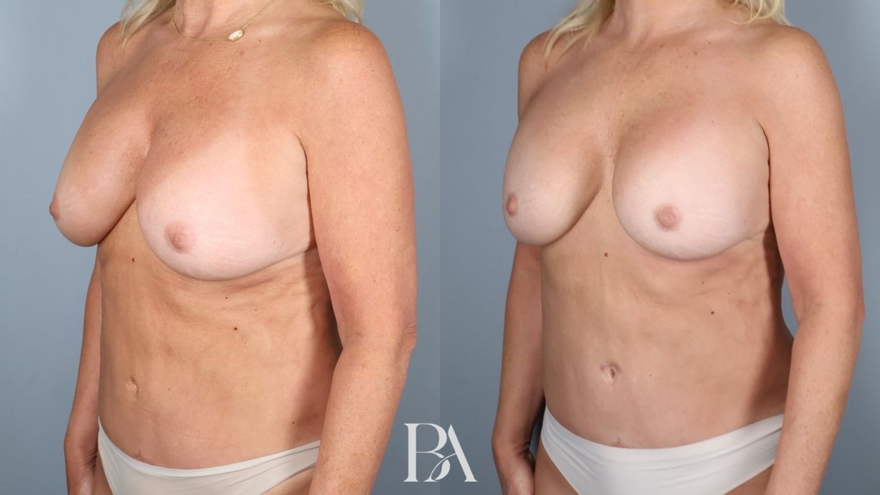 Implant Removal and Replacement before and after — three-quarter view, Dr. Beina Azadgoli, Beverly Hills