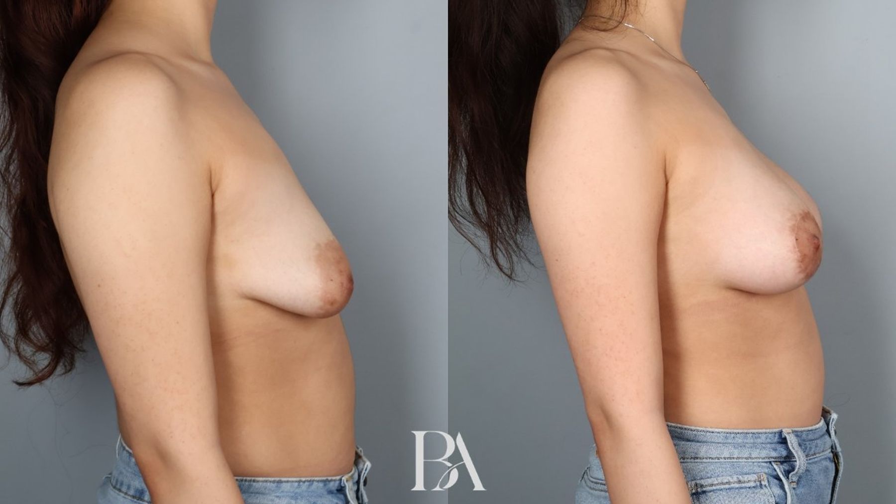 Breast Lift with Augmentation before and after — side view, Dr. Beina Azadgoli, Beverly Hills