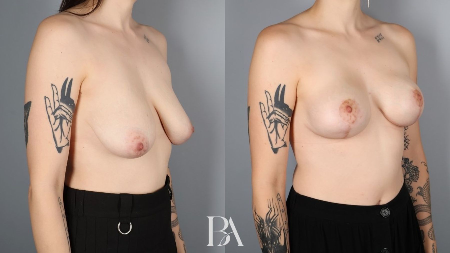 Breast lift before and after — oblique view, Dr. Beina Azadgoli, Beverly Hills