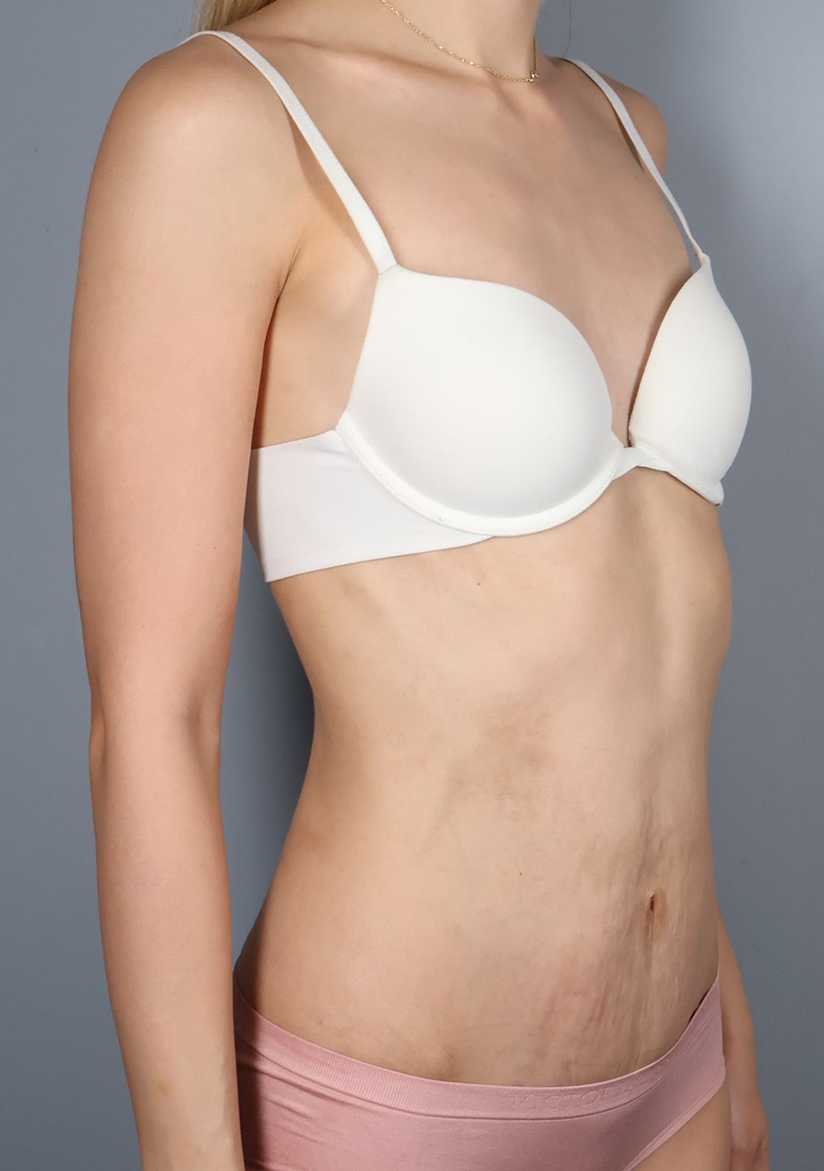 Rectus diastasis repair after — oblique view, Dr. Beina Azadgoli, Beverly Hills