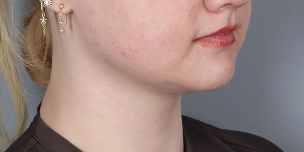 Case 4001 — Oblique after