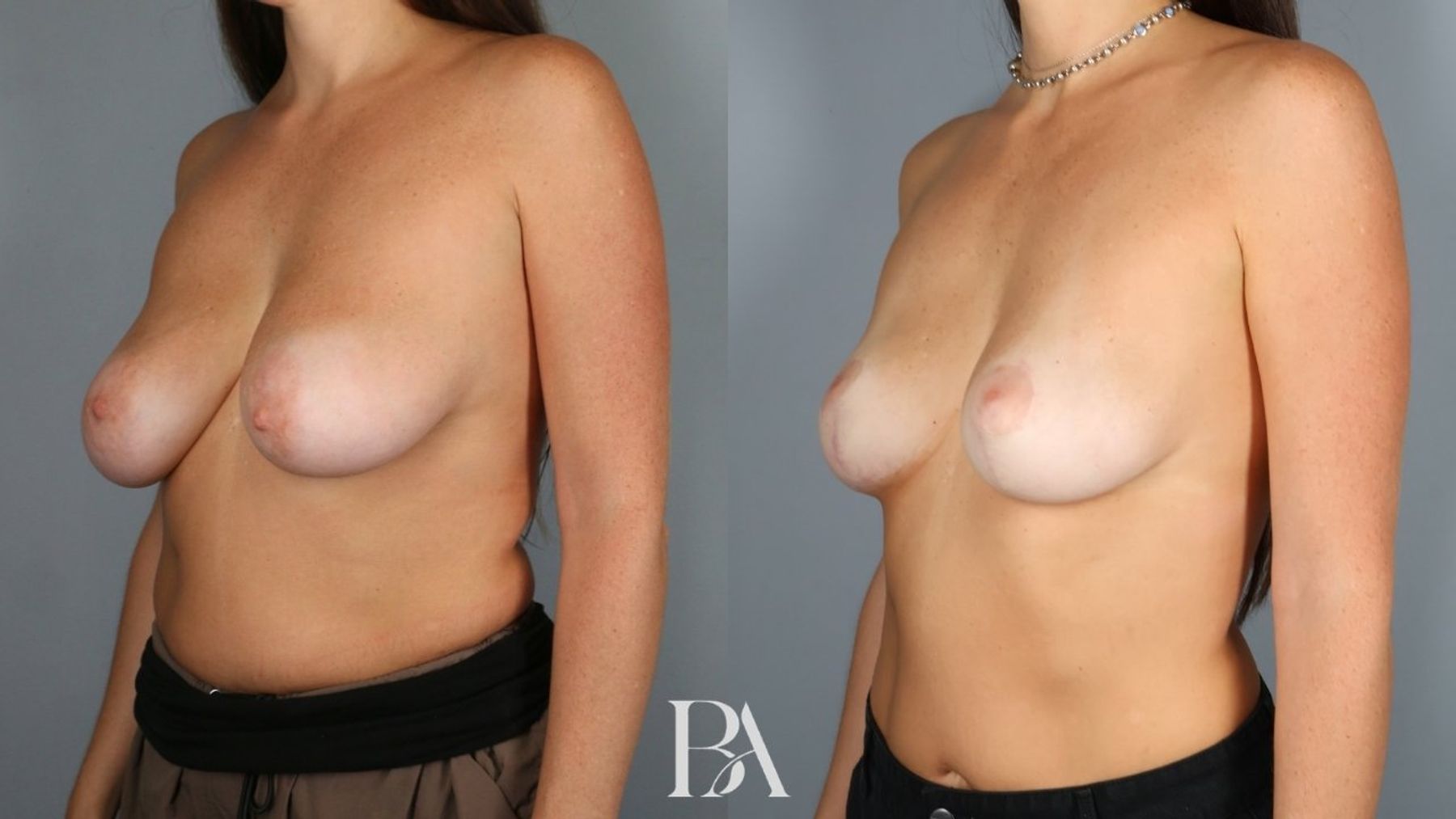 Breast lift before and after — three-quarter view, Dr. Beina Azadgoli, Beverly Hills