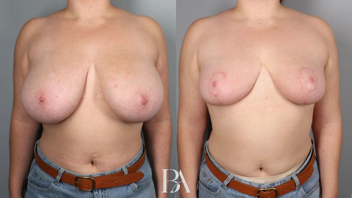 Before and after — Breast Reduction