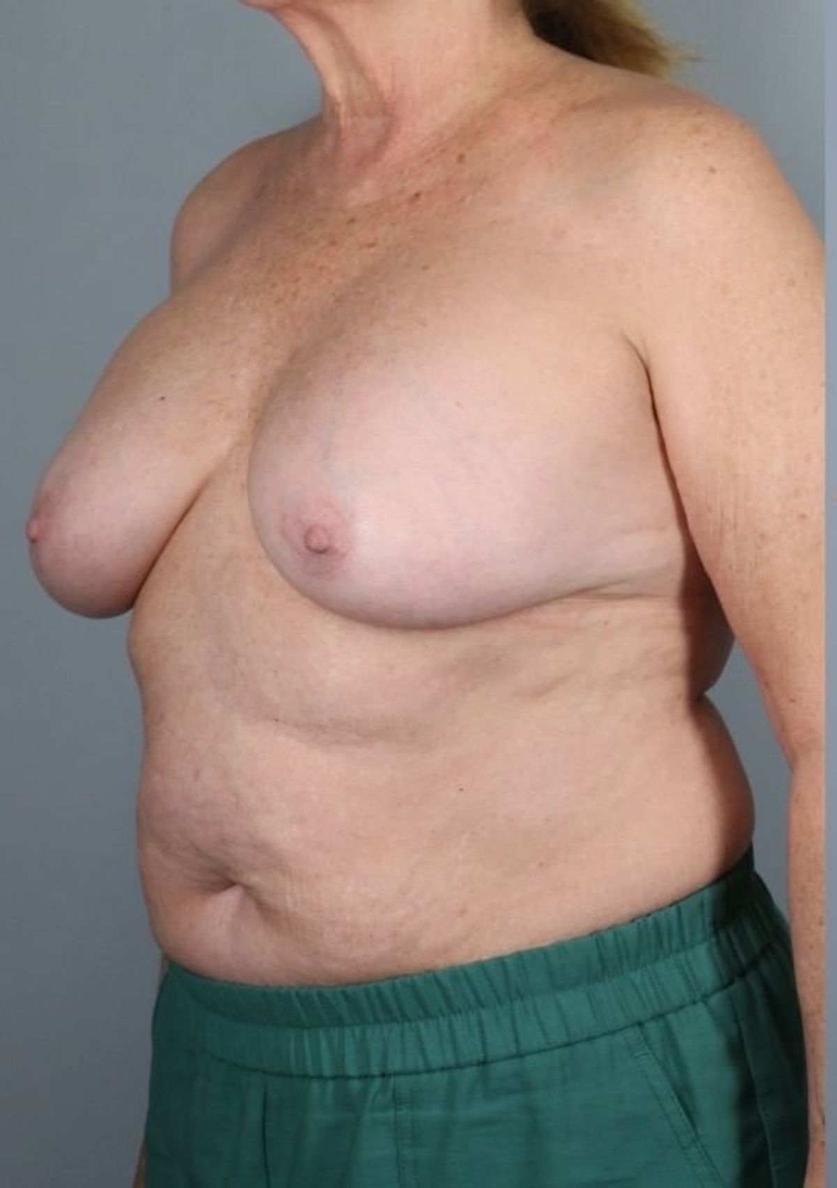 Breast implant removal before — oblique view, Dr. Beina Azadgoli, Beverly Hills