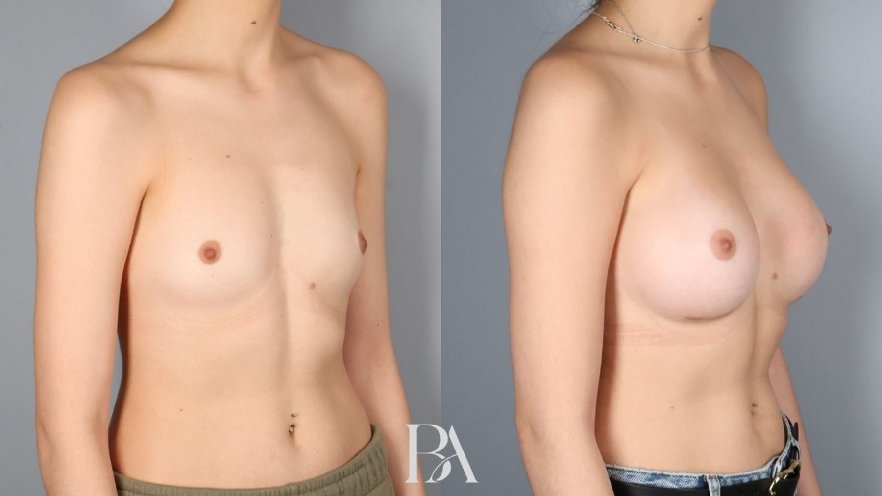 Breast augmentation before and after — oblique view, Dr. Beina Azadgoli, Beverly Hills