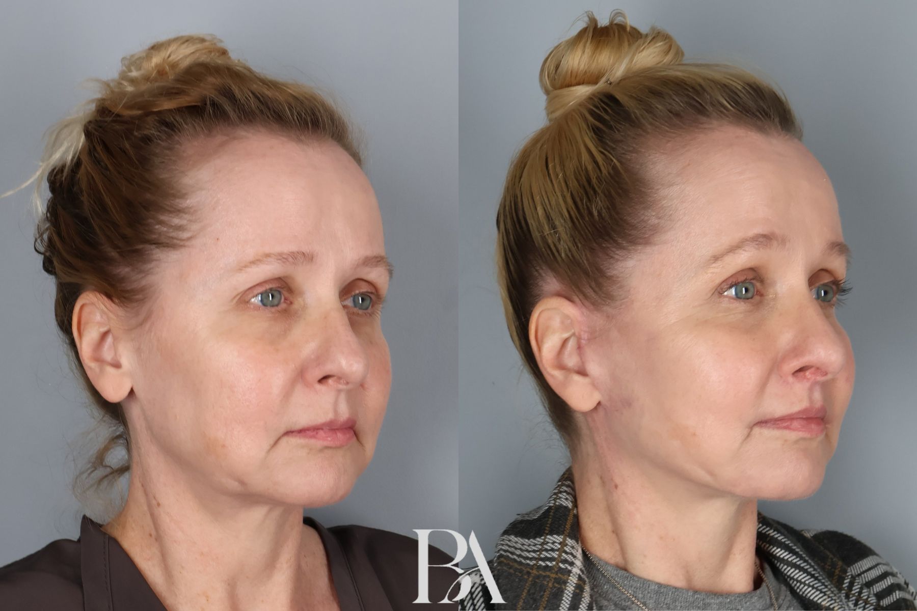 Face/Neck Lift before and after — oblique view, Dr. Beina Azadgoli, Beverly Hills