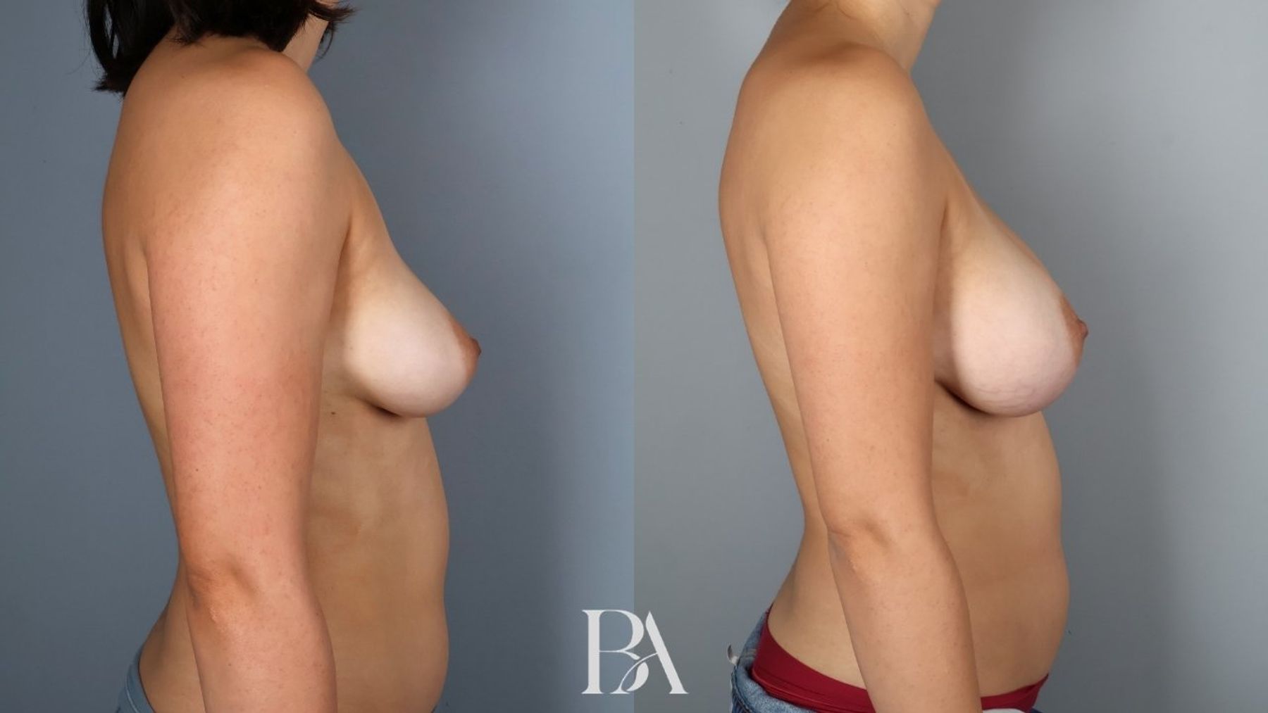Breast augmentation before and after — side view, Dr. Beina Azadgoli, Beverly Hills