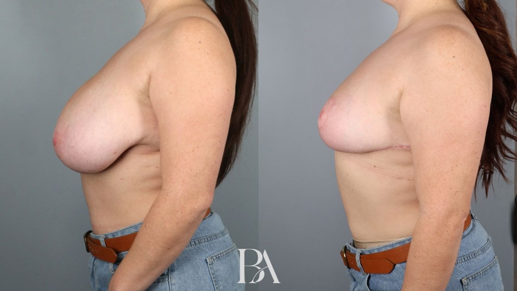 Breast reduction before and after — side view, Dr. Beina Azadgoli, Beverly Hills