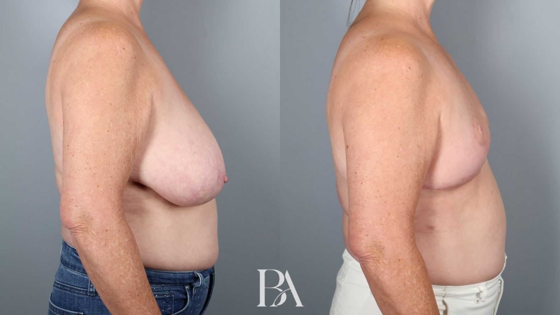 SWIM Flap Reconstruction before and after — side view, Dr. Beina Azadgoli, Beverly Hills
