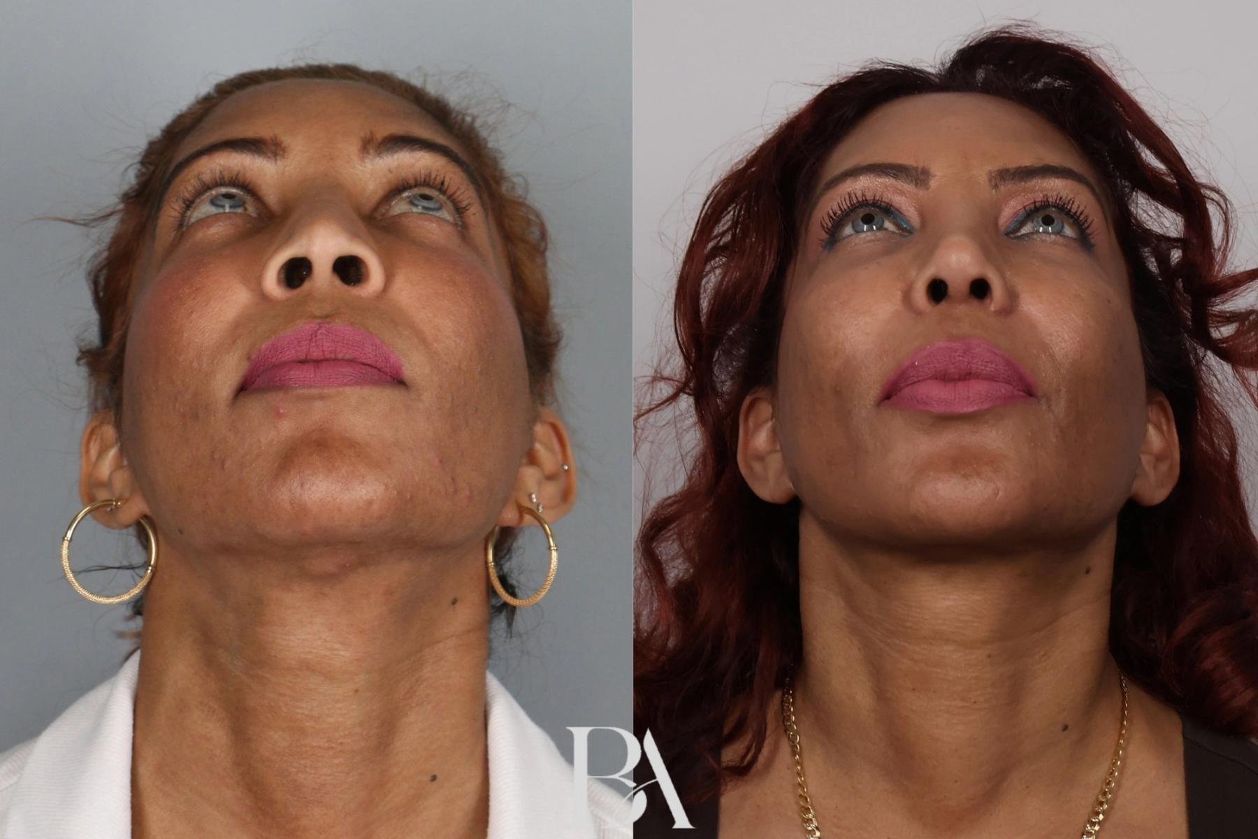 Rhinoplasty before and after — detail view, Dr. Beina Azadgoli, Beverly Hills