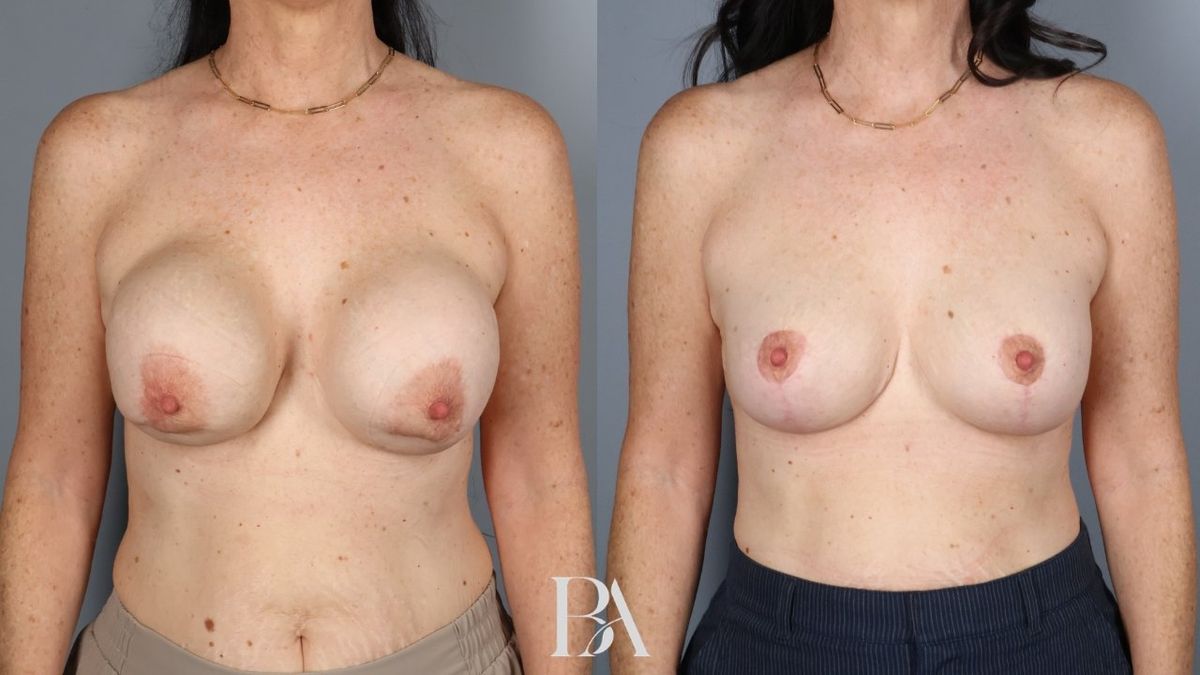 Before and after — Implant Removal and Replacement