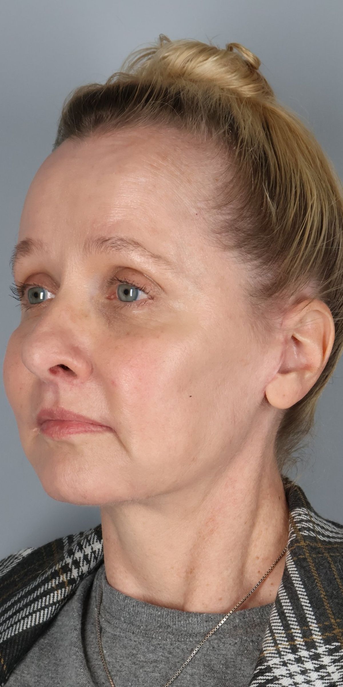 Face/neck lift after — three-quarter view, Dr. Beina Azadgoli, Beverly Hills