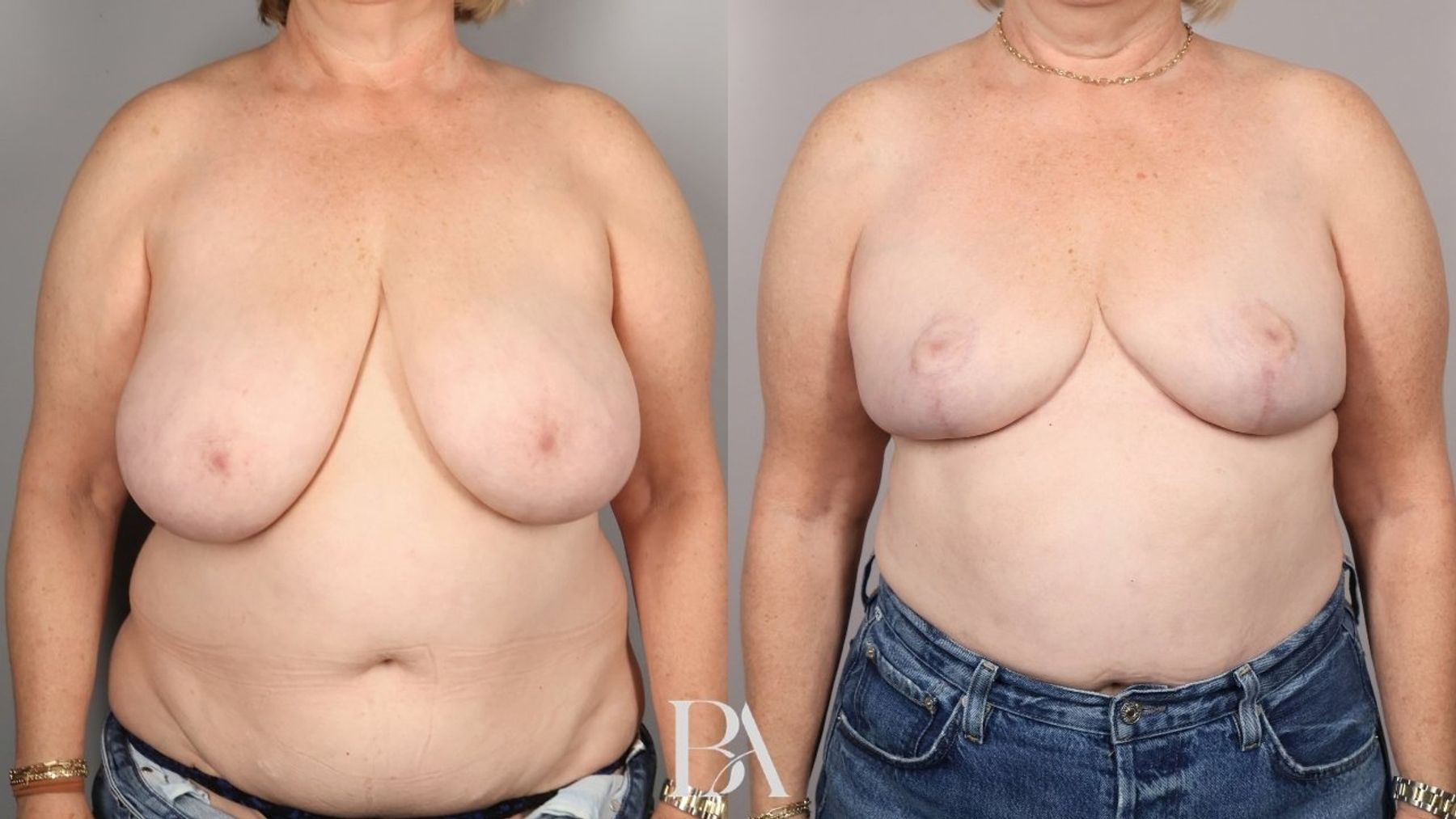 Breast reduction before and after — front view, Dr. Beina Azadgoli, Beverly Hills
