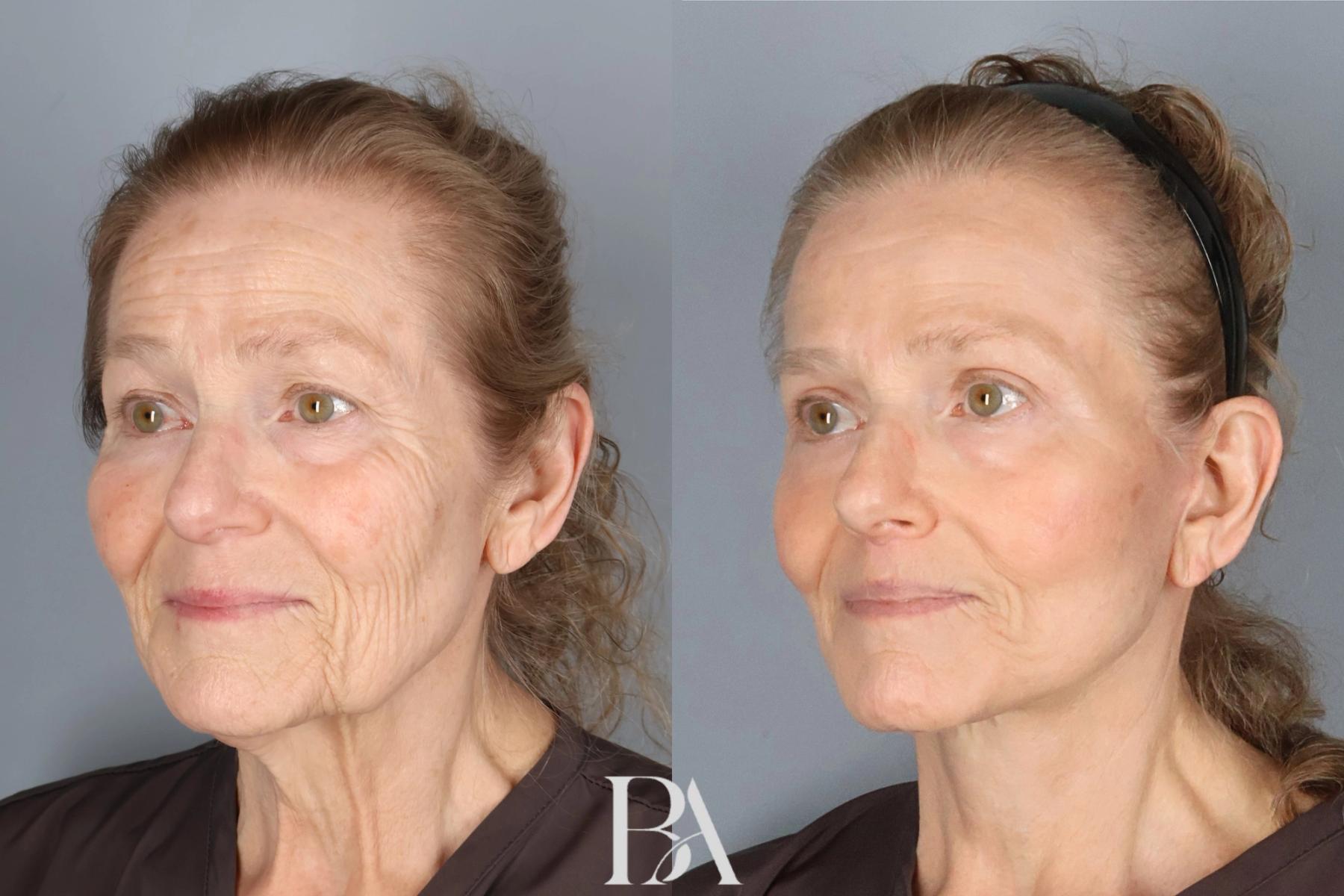 Face/Neck Lift before and after — three-quarter view, Dr. Beina Azadgoli, Beverly Hills
