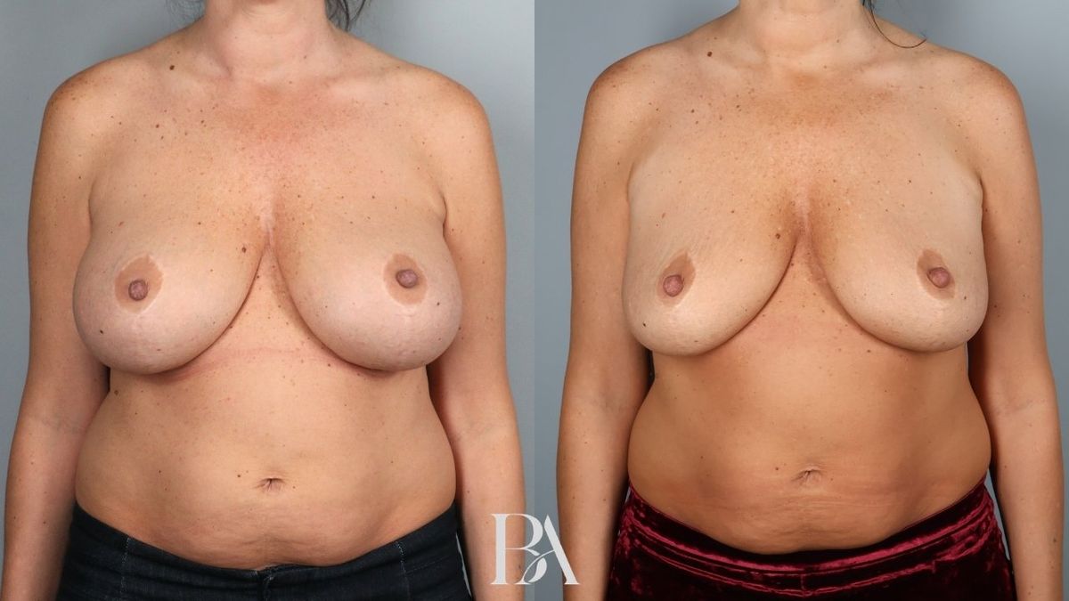 Before and after — Breast Implant Removal (+/- Lift)