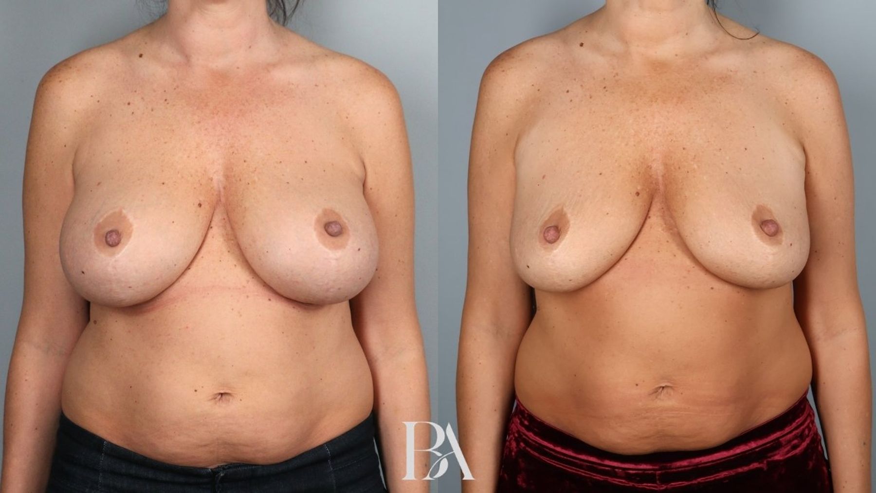 Breast implant removal before and after — front view, Dr. Beina Azadgoli, Beverly Hills