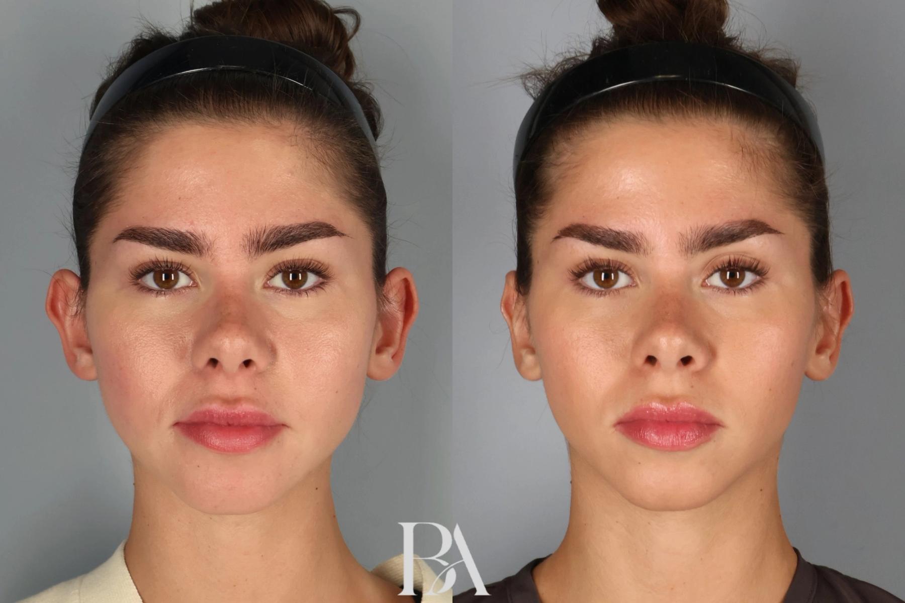 Ear Pinning before and after — front view, Dr. Beina Azadgoli, Beverly Hills