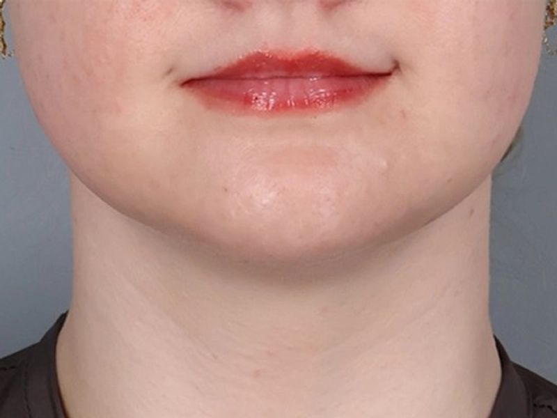 After — Submental Liposuction