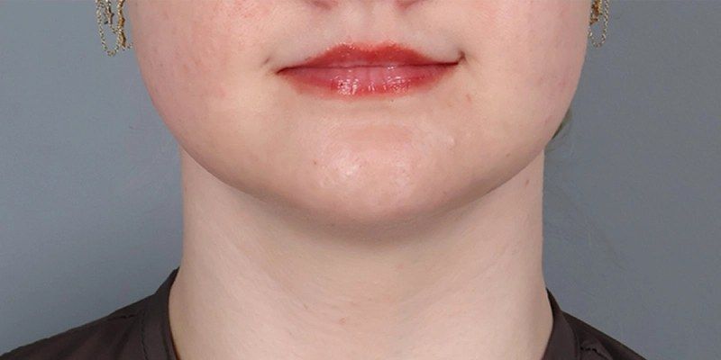 After — Submental Liposuction